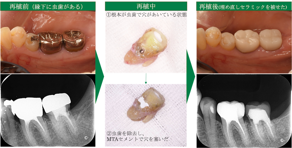 外科的歯内療法 再植