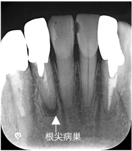 根管治療