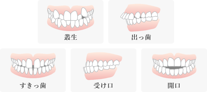 歯並びの種類