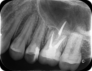 歯医者さんで撮影されるレントゲン写真って何？？
